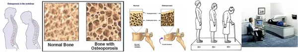 osteoporosis